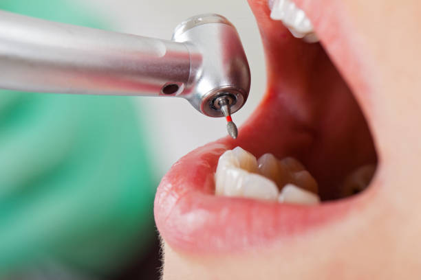 Best Emergency Wisdom Tooth Extraction in Chester, VA